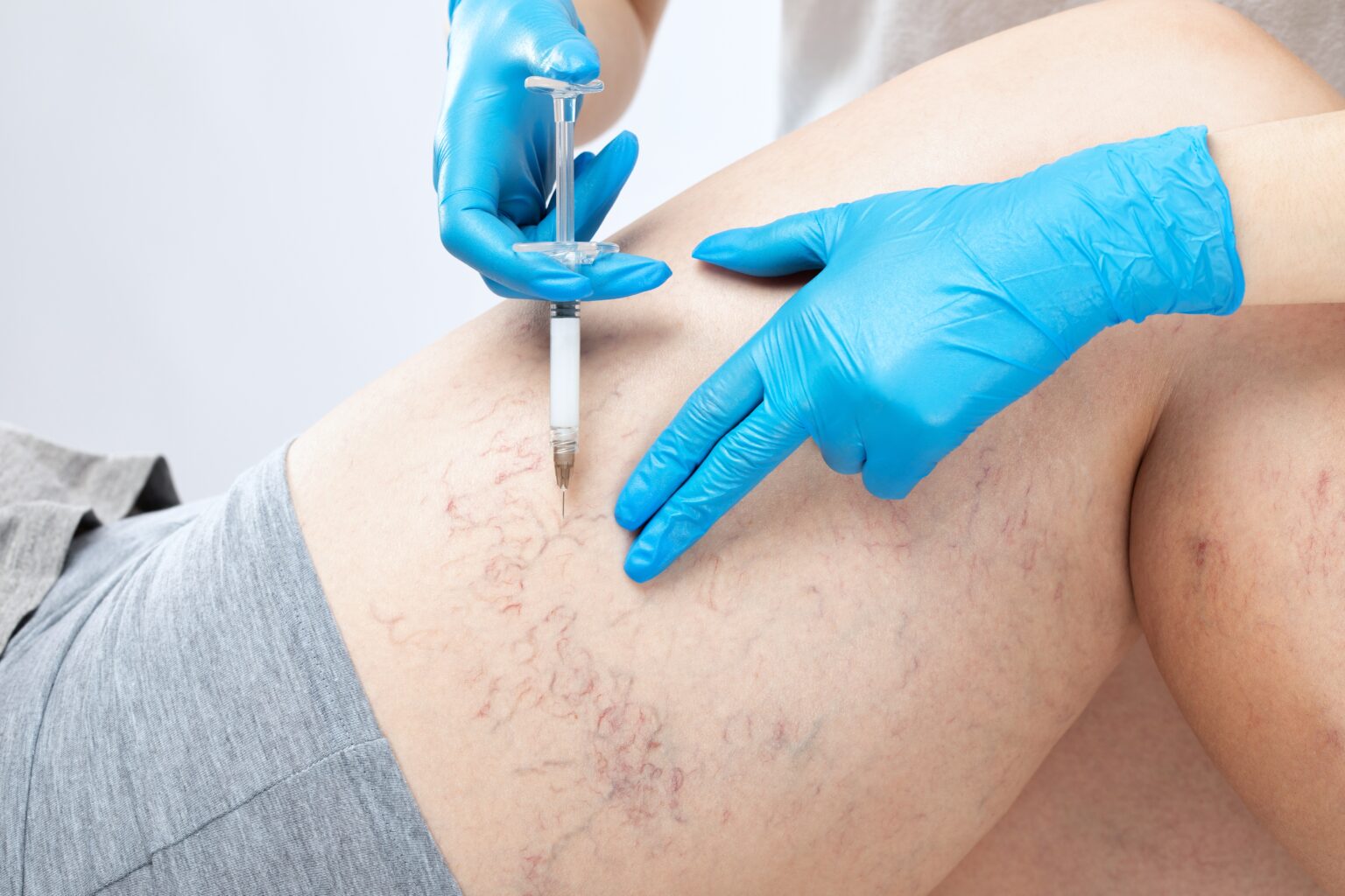 Spider Med Asclera Spider Vein Treatment in West Hollywood, CA