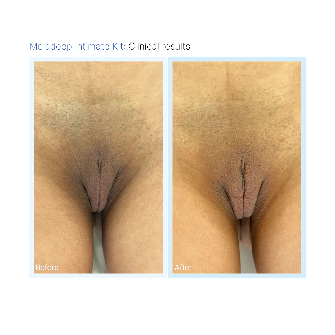 Meladeep-Intimate-Skin-Discoloration-Before-After